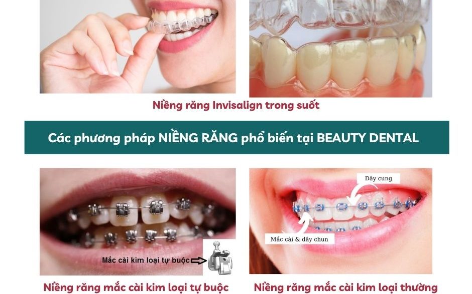 Các phương pháp niềng răng hiện có tại Beauty Dental