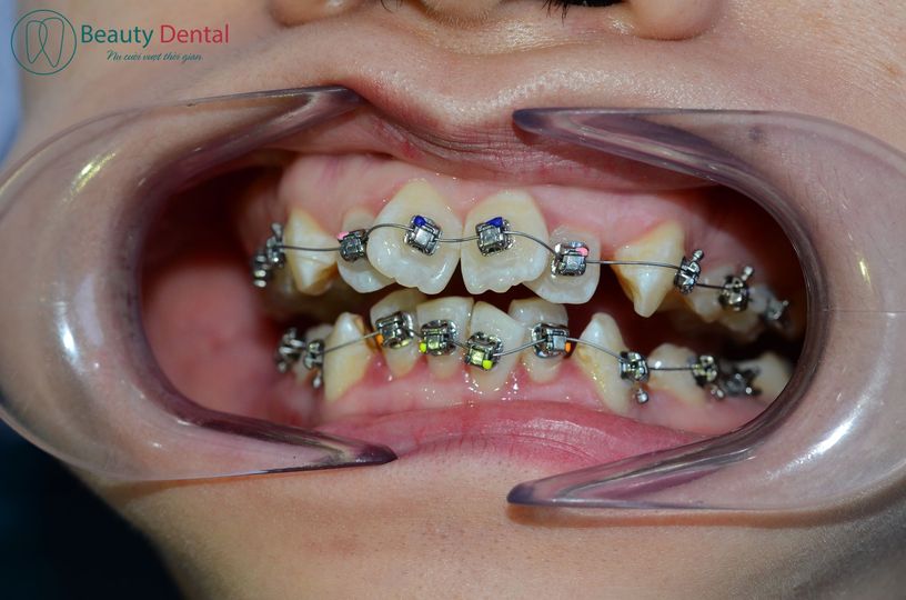 Niềng răng mắc cài được gợi ý cho nhiều vấn đề răng miệng