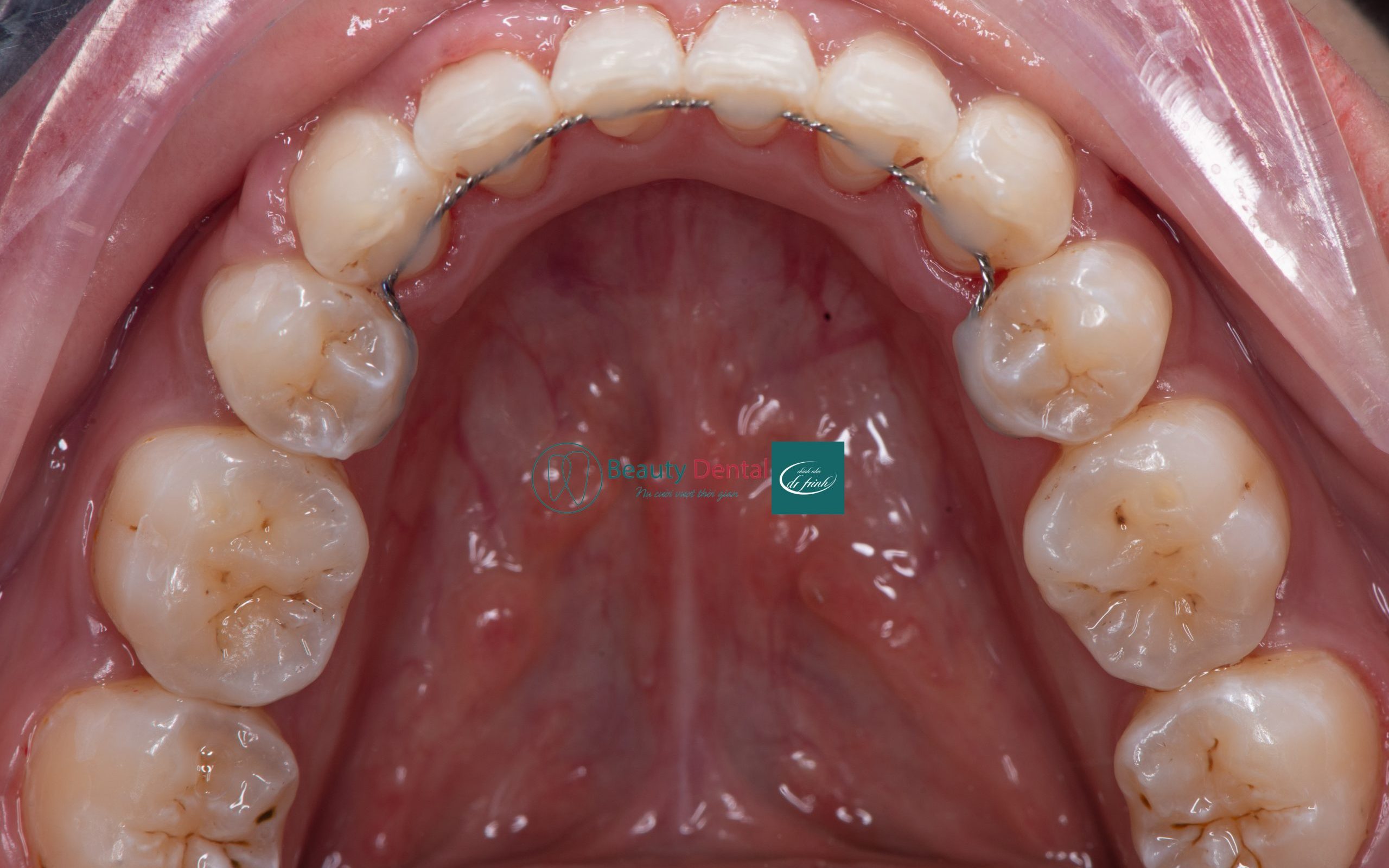 Hàm duy trì cố định sử dụng một dây kim loại để cố định răng