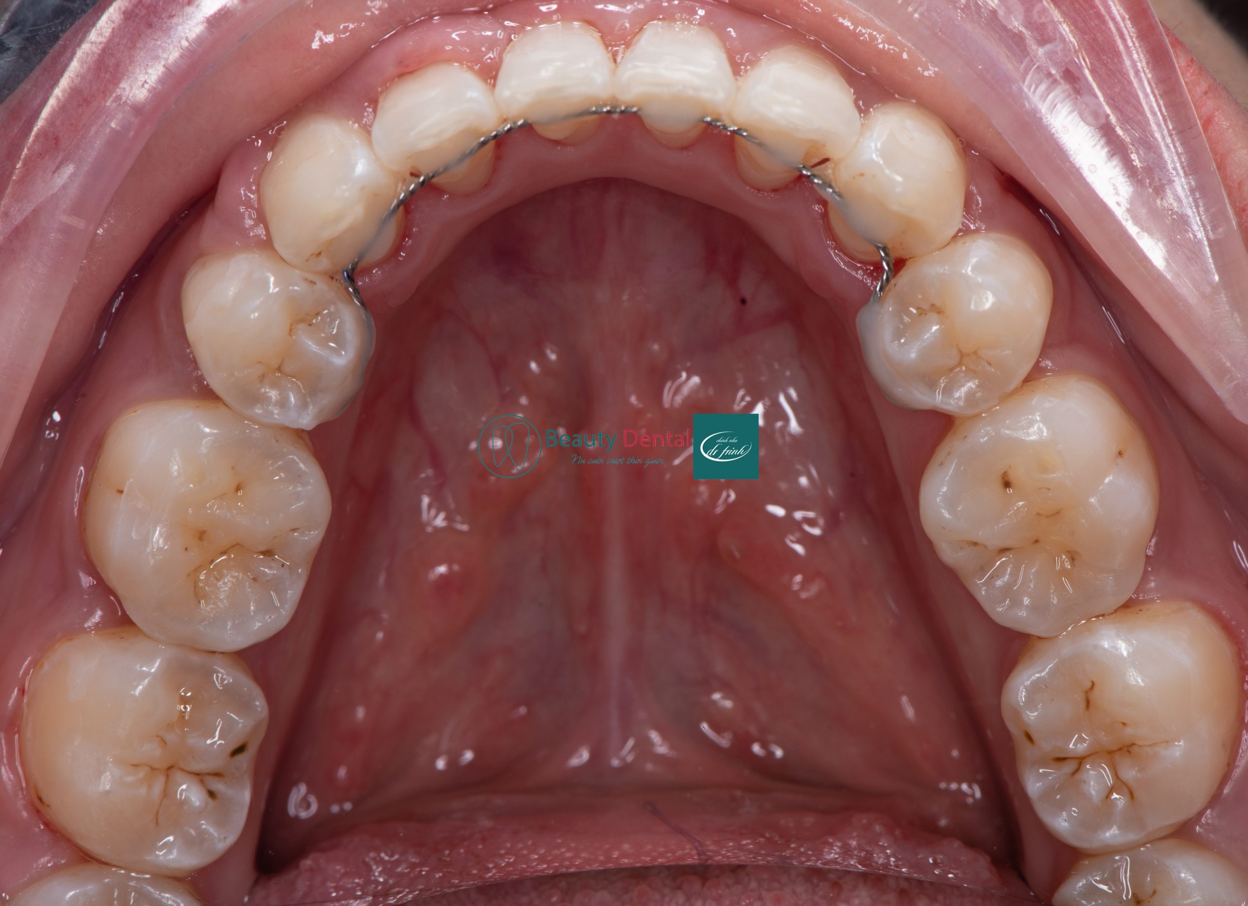 Hàm duy trì cố định sử dụng một dây kim loại để cố định răng