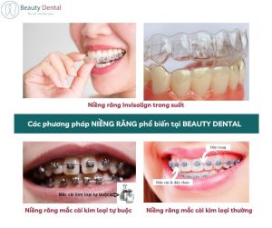 Các phương pháp niềng răng phổ biến tại Beauty Dental