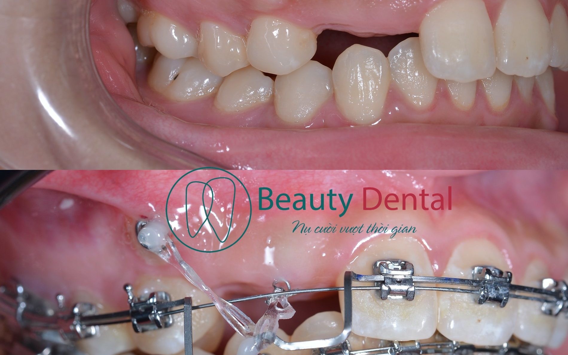 Niềng răng mắc cài kim loại tự buộc Damon Q được sử dụng nhiều nhất tại Beauty Dental