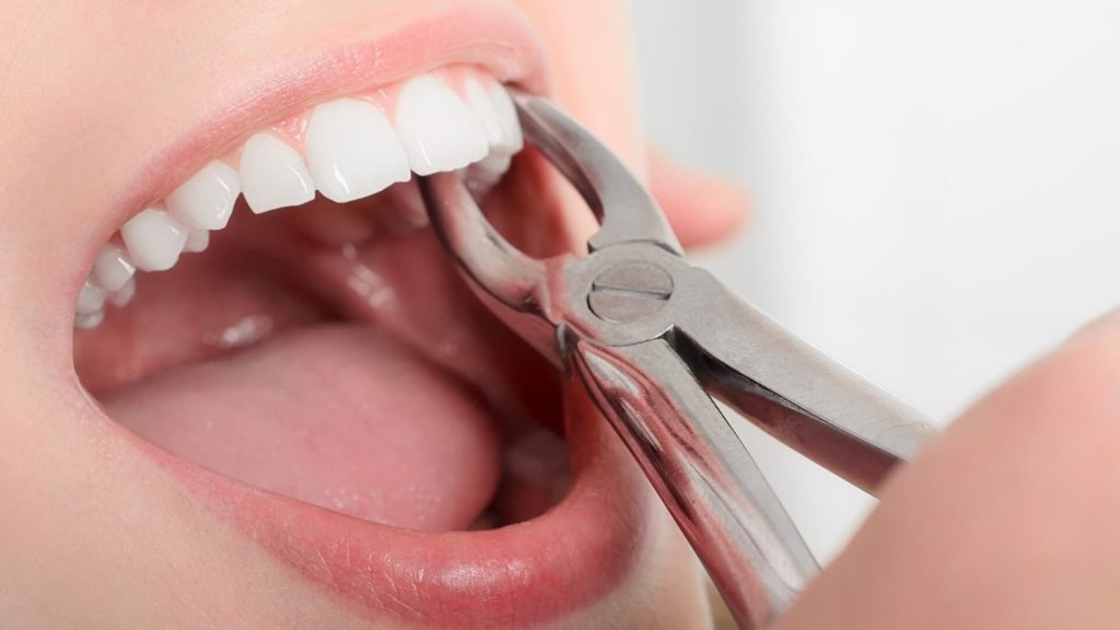 Bác sĩ sẽ nhổ một vài răng trong quá trình chỉnh nha