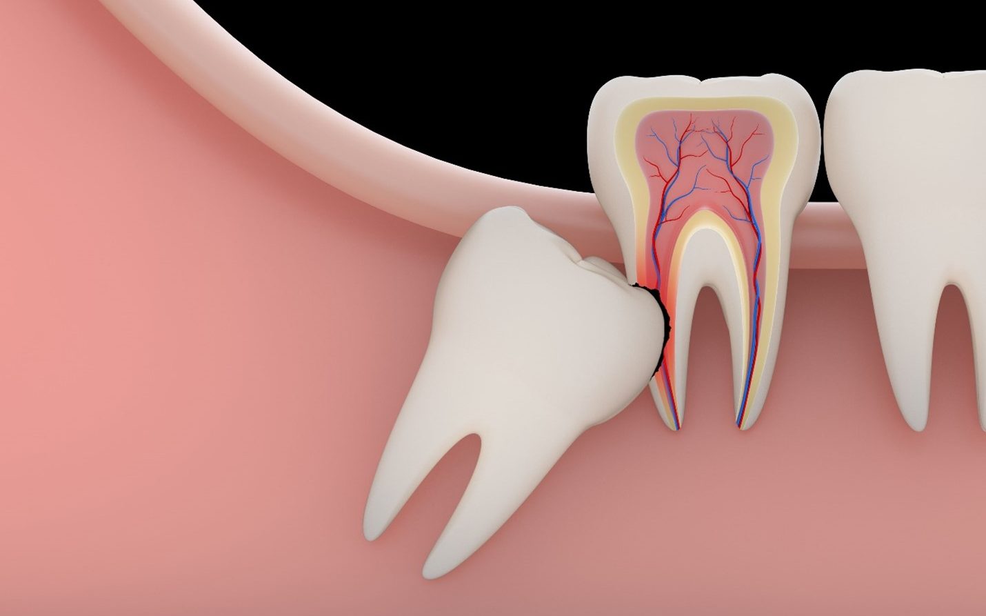 Nếu không mọc lệch thì răng khôn cũng có thể bị chỉ định nhổ khi niềng răng