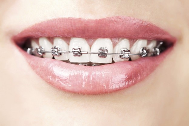 Niềng răng mắc cài sử dụng hệ thống các mắc cài để kéo chỉnh răng