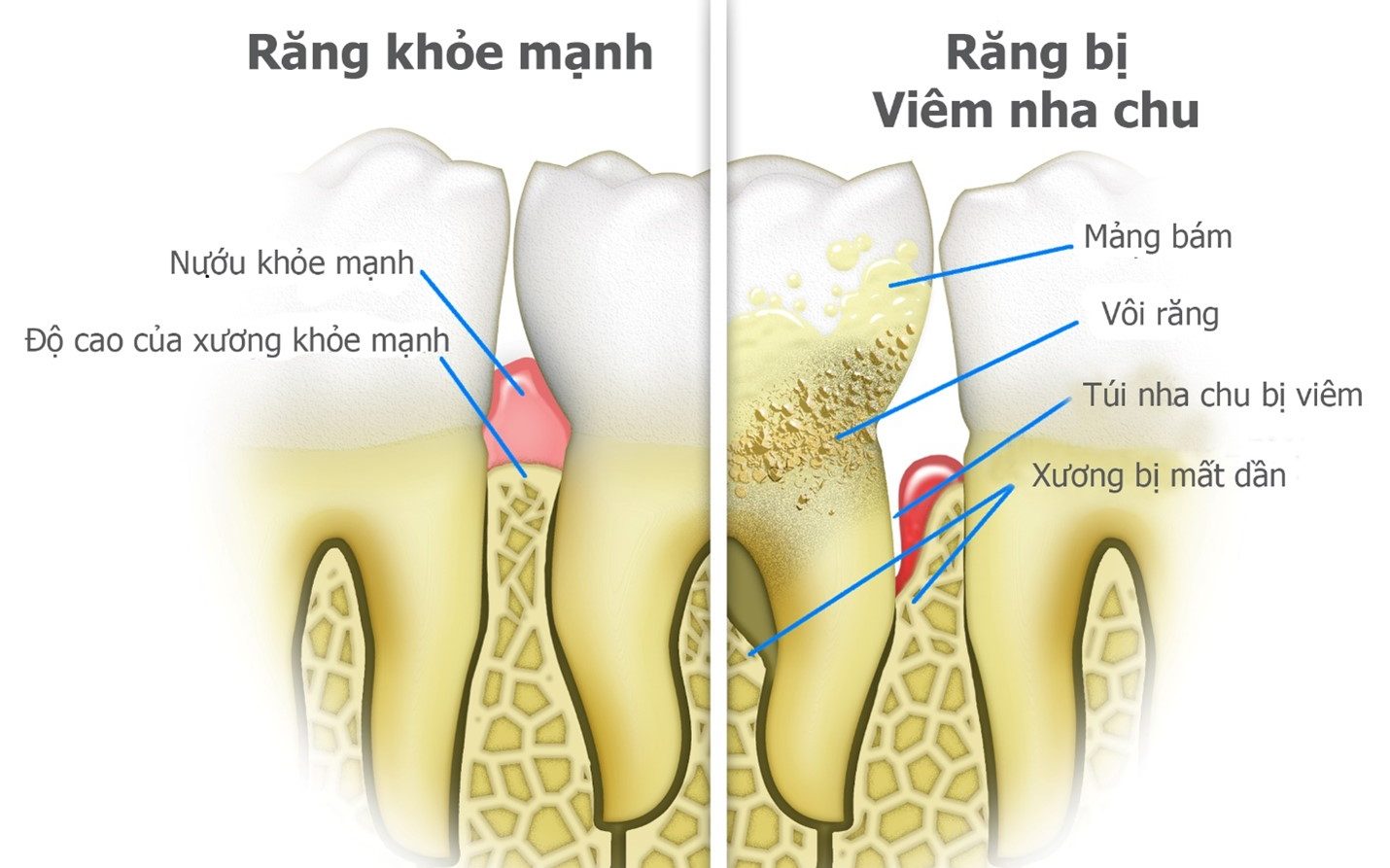 Viêm nha chu là bệnh nhiễm trùng nghiêm trọng