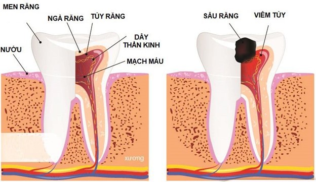 Viêm tủy răng là tình trạng vi khuẩn xâm nhập và tủy răng thông qua sâu răng