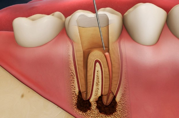 Áp xe răng là một trong những biến chứng của viêm quanh cuống chân răng