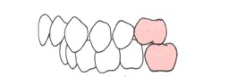 Sai khớp cắn loại II