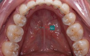 Tình trạng răng giúp bác sĩ quyết định răng nào nên nhổ để niềng răng đạt hiệu quả 