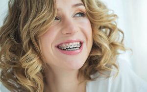 Beauty dental có chính sách trả góp trong niềng răng 