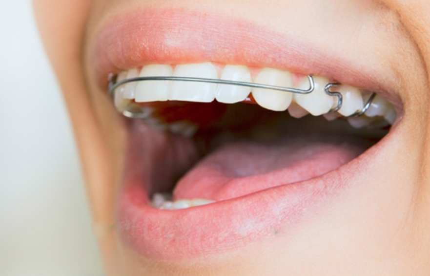 Dây cung là bộ phận không thể thiếu khi niềng răng mắc cài