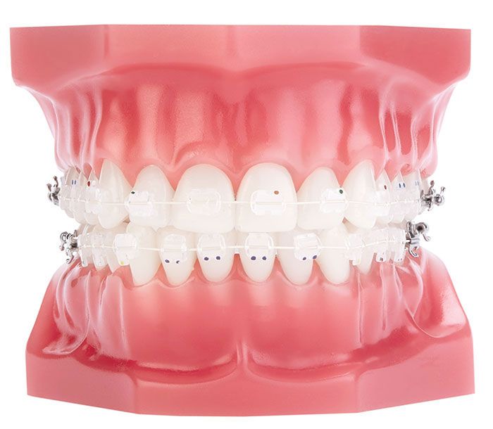Niềng răng bằng mắc cài sứ vừa hiệu quả vừa thẩm mỹ