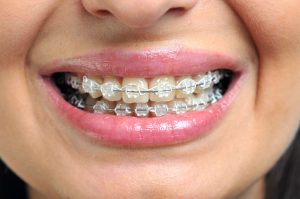 Beauty Dental có chính sách niềng răng trả góp cho mắc cài sứ