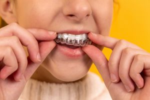 Niềng răng invisalign sử dụng khay niềng trong suốt