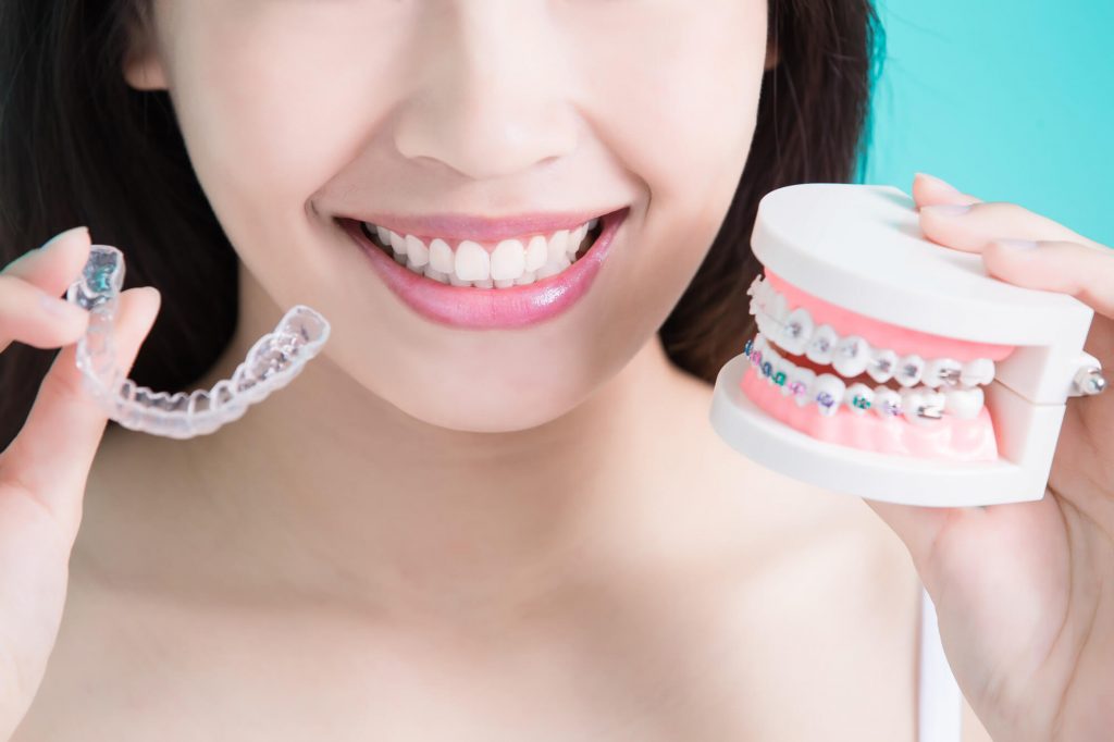 Máng niềng răng là một loại khí cụ chỉnh nha phổ biến 