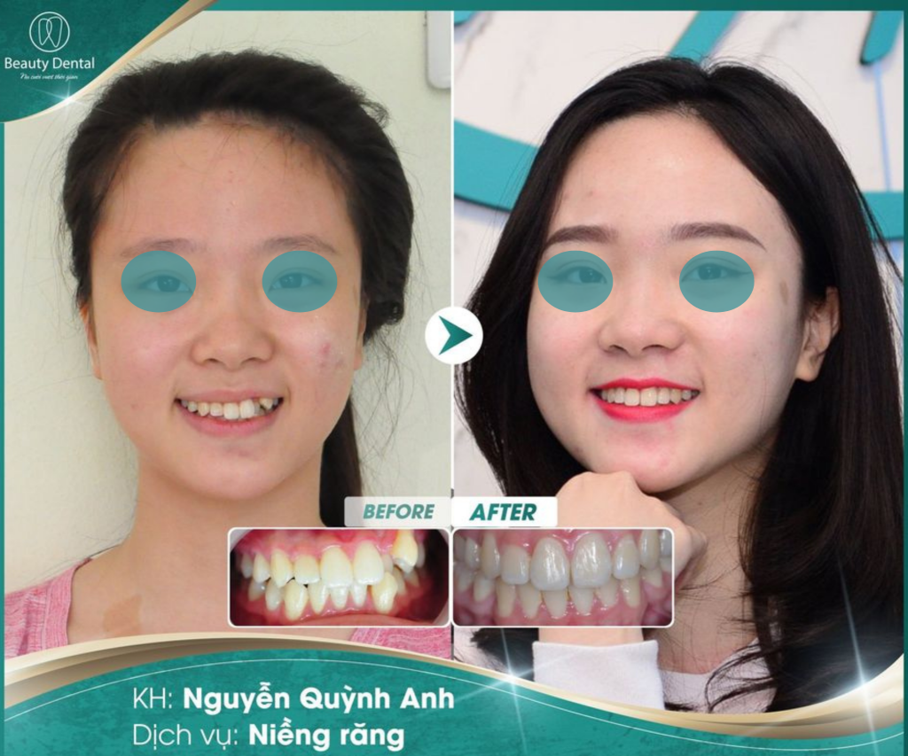 Khách hàng niềng răng khểnh để cải thiện tình trạng thẩm mỹ răng 