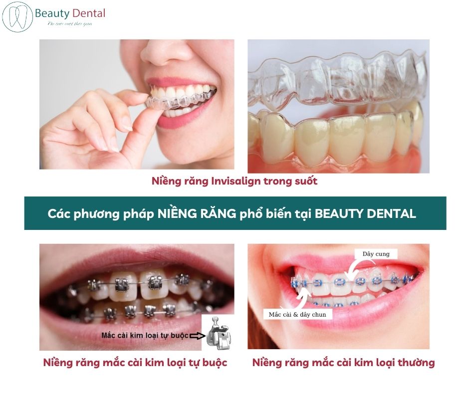 Niềng răng trong suốt là một trong bốn phương pháp niềng răng phổ biến tại Beauty Dental 