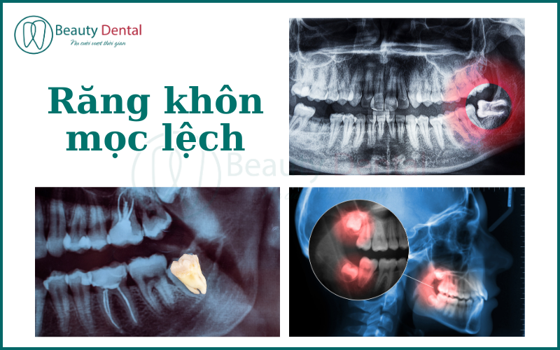 90% số người mọc răng khôn rơi vào trường hợp răng mọc lệch