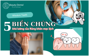 5 biến chứng khôn lường của răng khôn mọc lệch