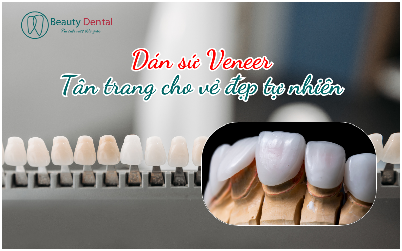 Dán sứ Veneer - giải pháp ít xâm lấn giúp răng đẹp một cách tự nhiên