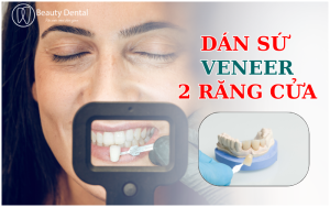 Dán sứ Veneer 2 răng cửa có thể là lựa chọn hoàn hảo để sửa chữa khuyết điểm tại vị trí mặt tiền