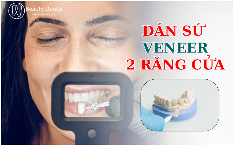 DÁN SỨ VENEER 2 RĂNG CỬA - GIẢI PHÁP THẨM MỸ CHO NỤ CƯỜI HOÀN HẢO ...
