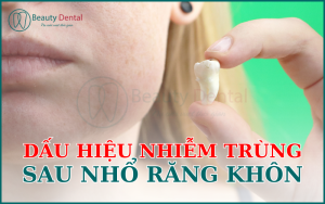 Dấu hiệu nhiễm trùng sau nhổ răng khôn