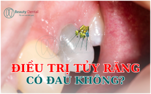 Điều trị tủy răng có đau không?