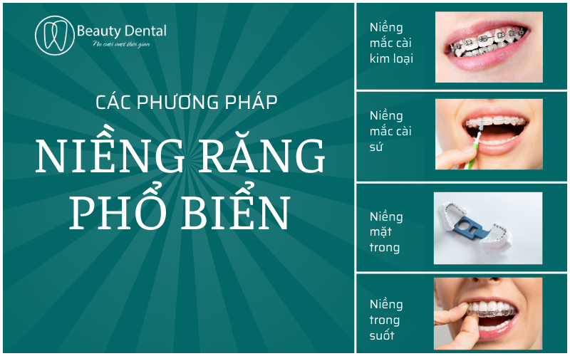 Các phương pháp niềng răng phổ biến hiện nay