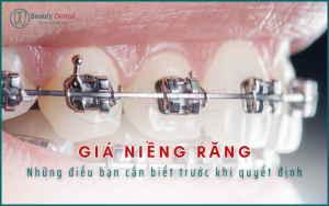 Giá niềng răng và những điều bạn cần biết