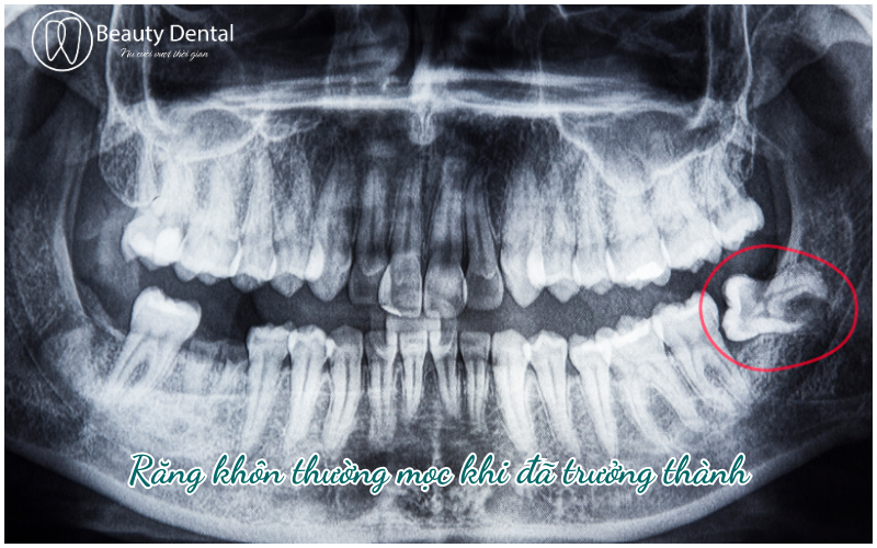 Gọi là răng "khôn", vì những chiếc răng cuối cùng trên hàm này thường mọc khi bước vào tuổi trưởng thành