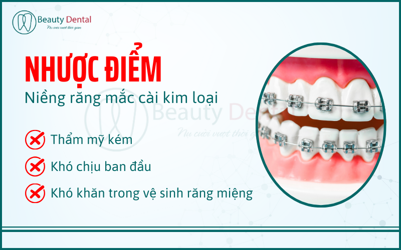 Nhược điểm của niềng răng mắc cài kim loại