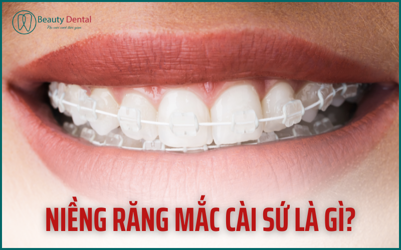 Niềng răng bằng mắc cài sứ là phương pháp có thẩm mỹ cao hơn so với mắc cài kim loại