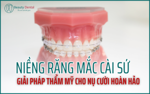 Niềng răng mắc cài sứ - giải pháp cho nụ cười hoàn hảo