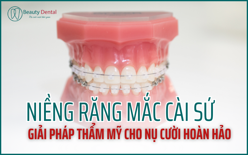 Niềng răng mắc cài sứ - giải pháp cho nụ cười hoàn hảo