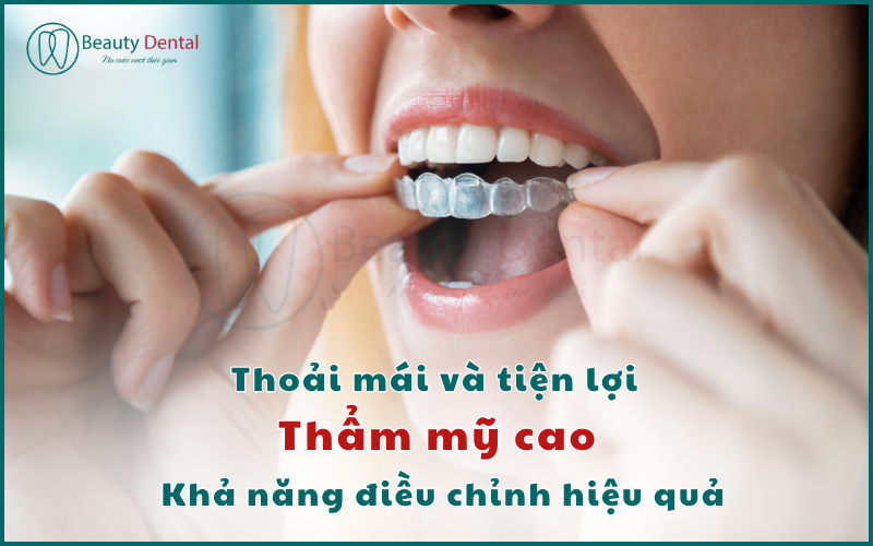 Ưu điểm của niềng răng trong suốt