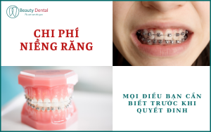 Chi phí niềng răng - mọi điều cần biết trước khi quyết định