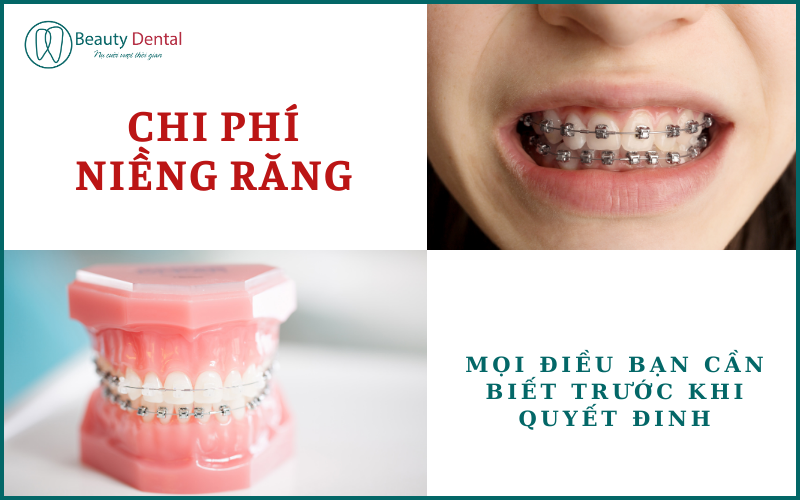 Chi phí niềng răng - mọi điều cần biết trước khi quyết định