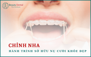 Chỉnh nha - hành trình sở hữu nụ cười khỏe đẹp