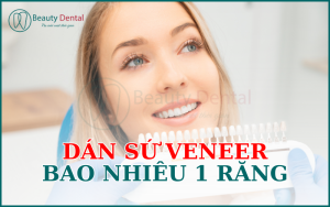 Dán sứ Veneer giá bao nhiêu 1 răng