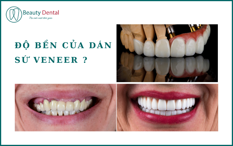 Giữ gìn chăm sóc thật tốt, dán sứ Veneer có thể đẹp từ 10-15 năm