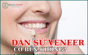 Dán sứ Veneer có bền không?