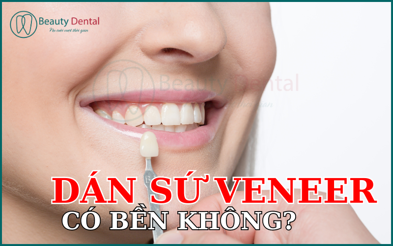 Dán sứ Veneer có bền không?