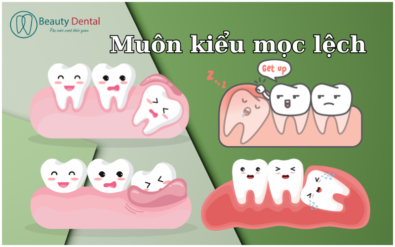 Răng khôn và muôn hình vạn trạng kiểu mọc bất cần