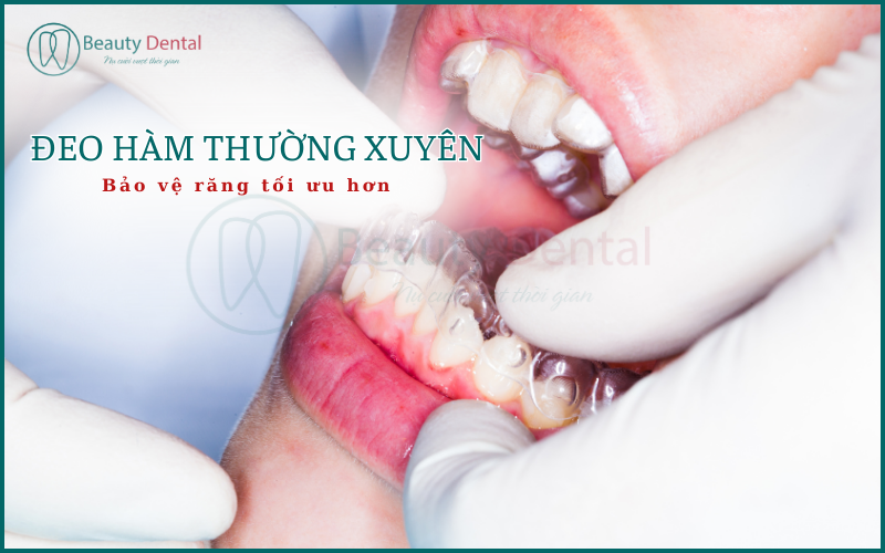 Cần đeo hàm duy trì thường xuyên để đảm bảo hiệu quả