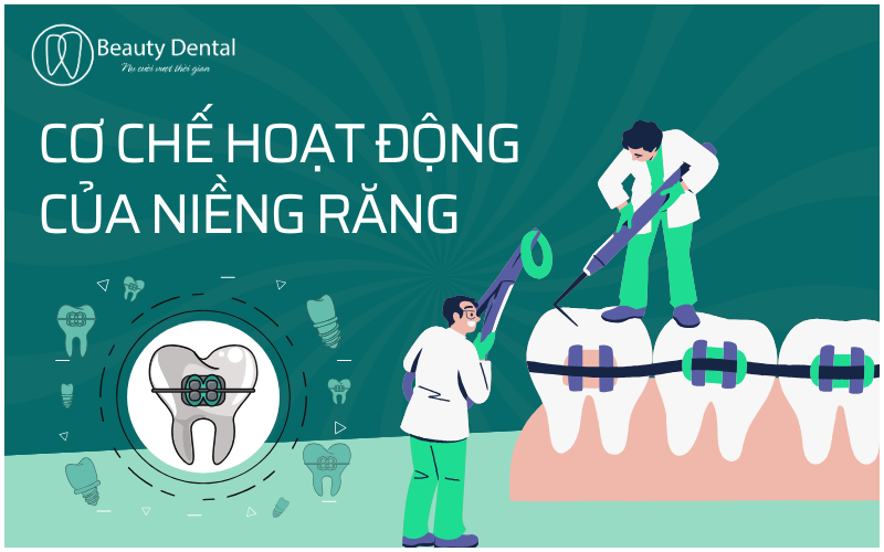 Cơ chế hoạt động của niềng răng