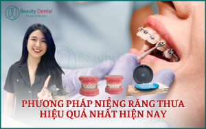 Phương pháp niềng răng thưa hiệu quả nhất hiện nay