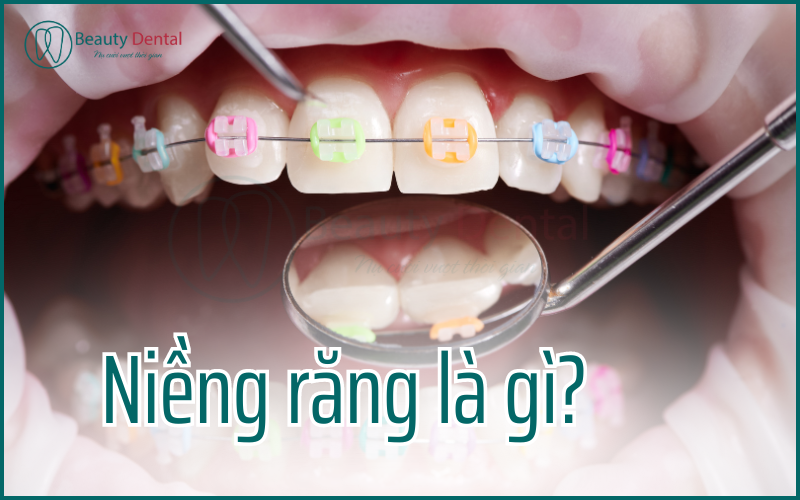 Niềng răng hay còn gọi là chỉnh nha, là phương pháp phổ biến giúp nắn chỉnh răng về đúng vị trí trên cung hàm