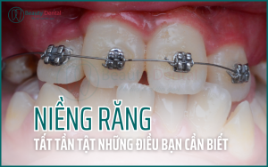 Niềng răng và những điều cần biết